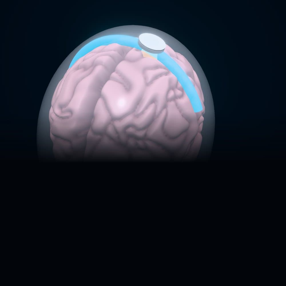 A detailed brain inside a see-through head, with the implant on its glowing motor strip